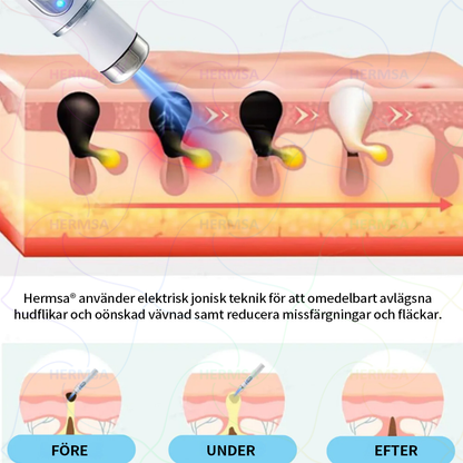 Hermsa® icke-invasiv laserpekare - borttagning av födelsemärken och vårtor