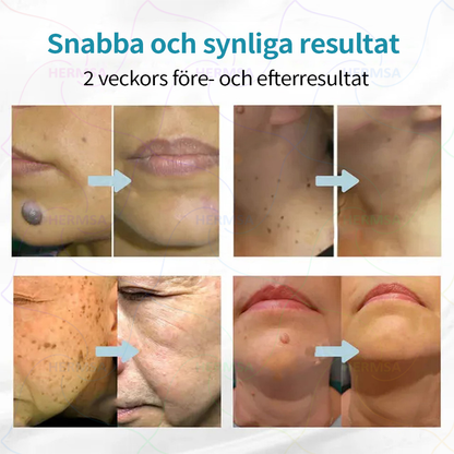 Hermsa® icke-invasiv laserpekare - borttagning av födelsemärken och vårtor