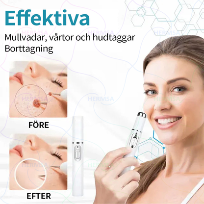Hermsa® icke-invasiv laserpekare - borttagning av födelsemärken och vårtor
